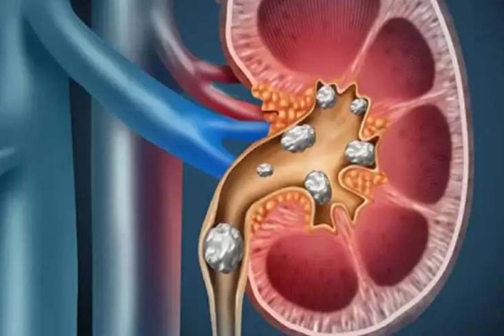 Urine Berwarna Gelap: Pertanda Tersembunyi Batu Ginjal? Konsultasi Ahli untuk Pemahaman Lebih Jernih